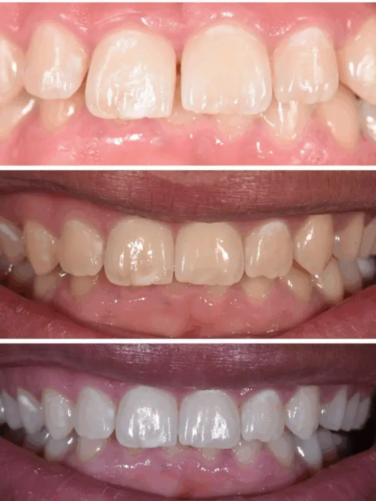Blanchiment : Nos soins cabinet dentaire boujenah, paris 16 : Soins dentaires généraux, Blanchiment dentaire, invisalign, Implants dentaires, Prothèses dentaires, Injection d’acide hyaluronique, Orthodontie invisible : Aligneurs transparents