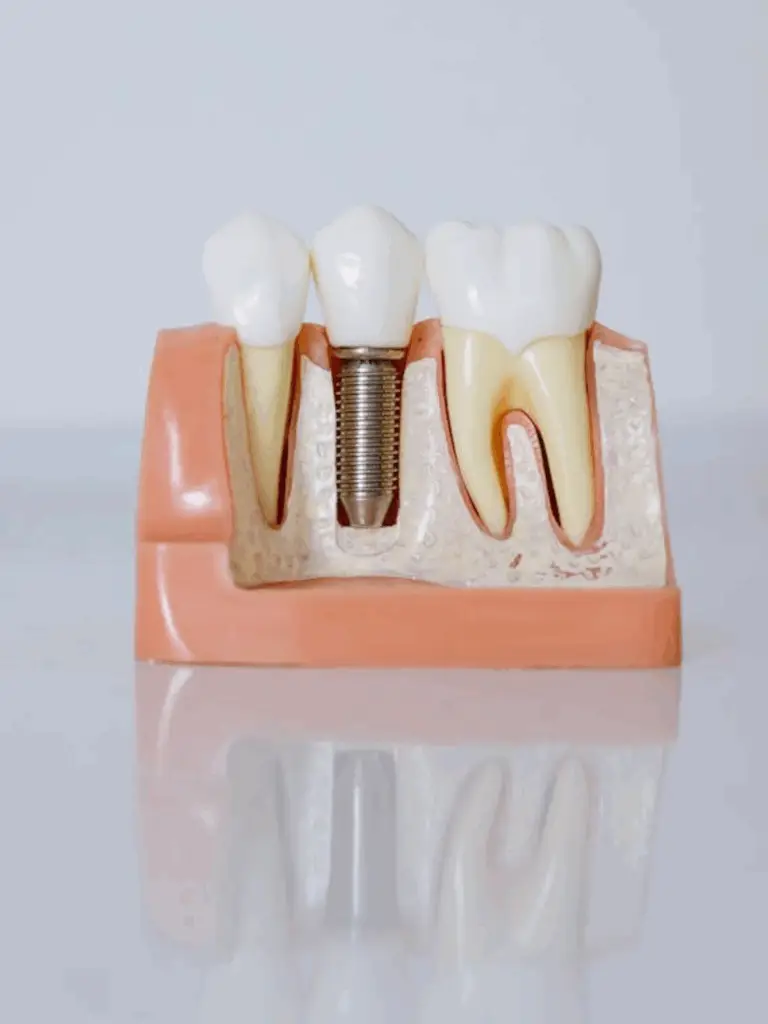 Implant Dentaire : Nos soins cabinet dentaire boujenah, paris 16